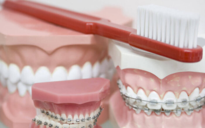 Everything You Need to Know About Dental Instruments for Braces